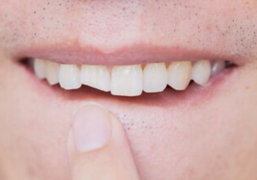 How to Repair Chip in The Teeth: A Comprehensive Guide