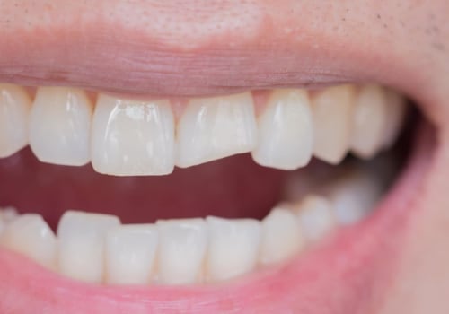 Is it Worth Repairing a Chipped Tooth?