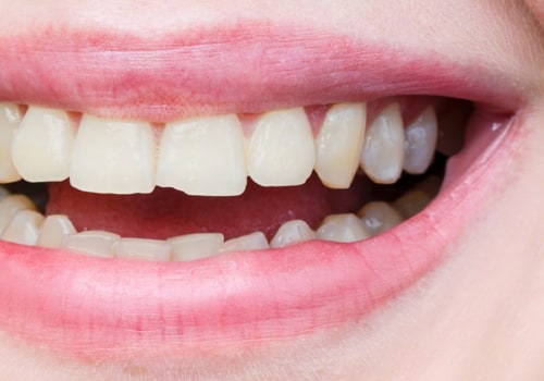 Can a Chipped Tooth be Permanently Fixed?