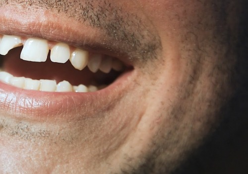 Is a Chipped Tooth Serious? Expert Advice on Treatment and Prevention